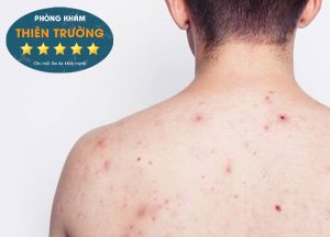 Hình ảnh: Mụn lưng.