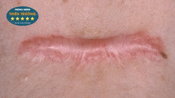 Hình ảnh: Sẹo lồi