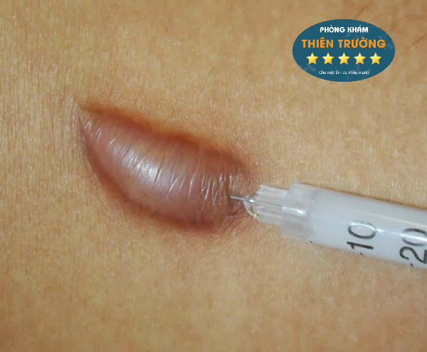 Hình ảnh: Tiêm nội sẹo.