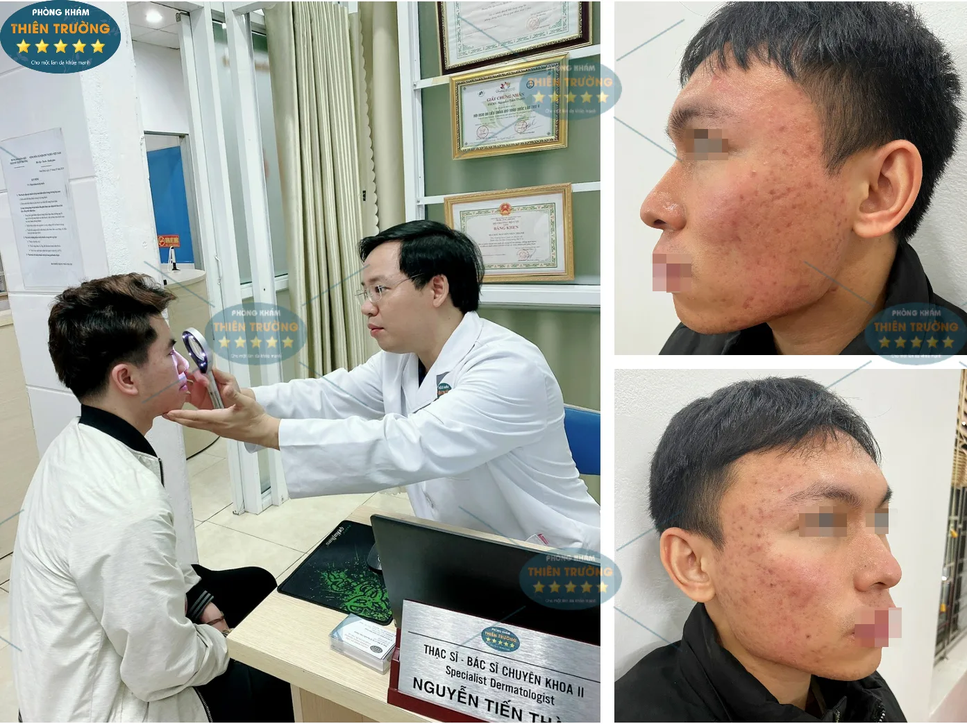 Hình ảnh: Mụn trứng cá.