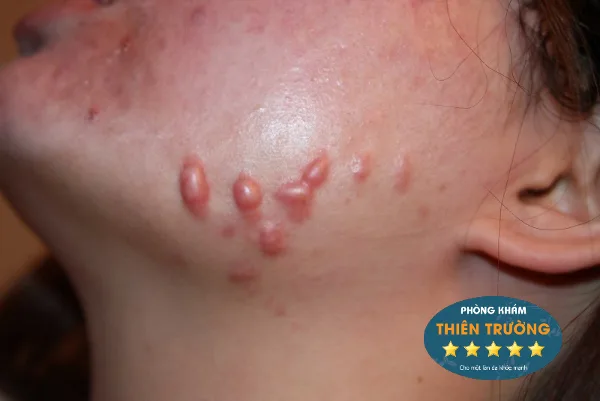 Hình ảnh: Sẹo lồi viền hàm.