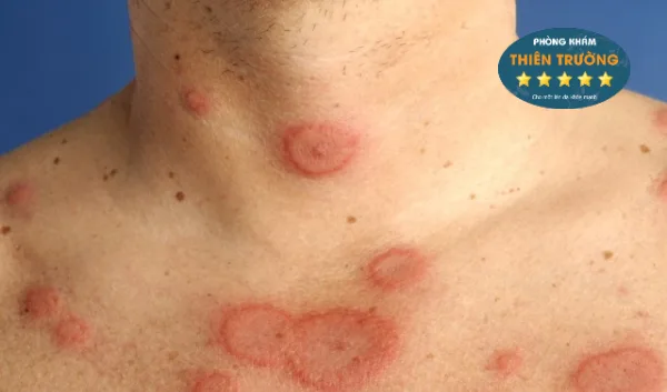 Hình ảnh: Triệu chứng của bệnh viêm da tiếp xúc dị ứng.