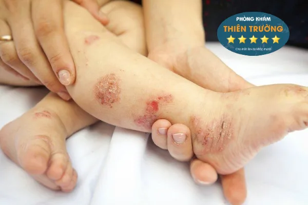 Hình ảnh: Viêm da tiếp xúc ở trẻ em.