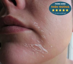 Hình ảnh: Da khô.