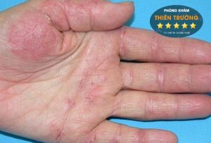 Hình ảnh: Viêm da ở lòng bàn tay.