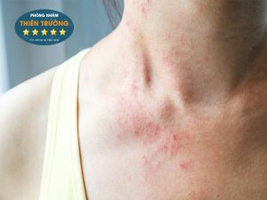 Hình ảnh: Viêm da cơ địa của khách hàng.