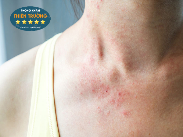 Hình ảnh: Viêm da cơ địa của khách hàng.