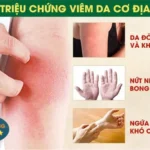 Hình ảnh: Triệu chứng của viêm da cơ địa.