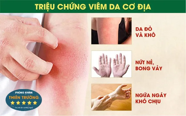 Hình ảnh: Triệu chứng của viêm da cơ địa. 