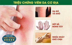 Hình ảnh: Triệu chứng của viêm da cơ địa.