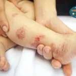 Hình ảnh: Viêm da cơ địa ở trẻ.