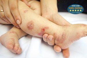 Hình ảnh: Viêm da cơ địa ở trẻ.