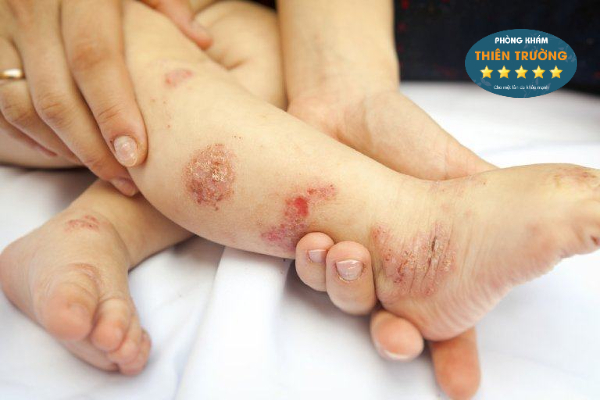 Hình ảnh: Viêm da cơ địa ở trẻ.