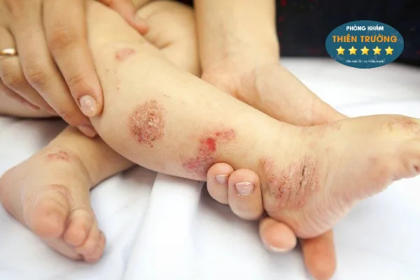 Hình ảnh: Viêm da cơ địa ở trẻ.