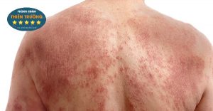 Hình ảnh: Viêm da