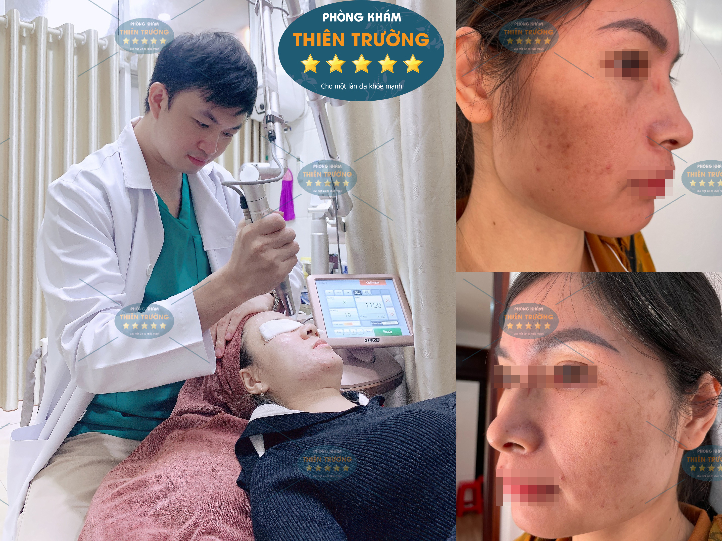 Hình ảnh: Thạc sĩ- Bác sĩ Nguyễn Văn Hoàn đang hỗ trợ điều trị nám- tàn nhang cho bệnh nhân.