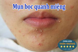 Hình ảnh: Mụn mọc quanh miệng.