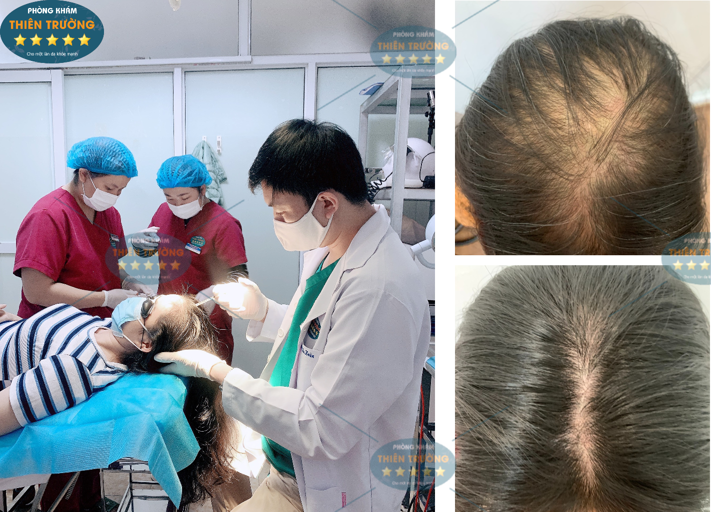 Hình ảnh: Thạc sĩ – Bác sĩ Nguyễn Văn Hoàn đang hỗ trợ điều trị rụng tóc cho bệnh nhân.