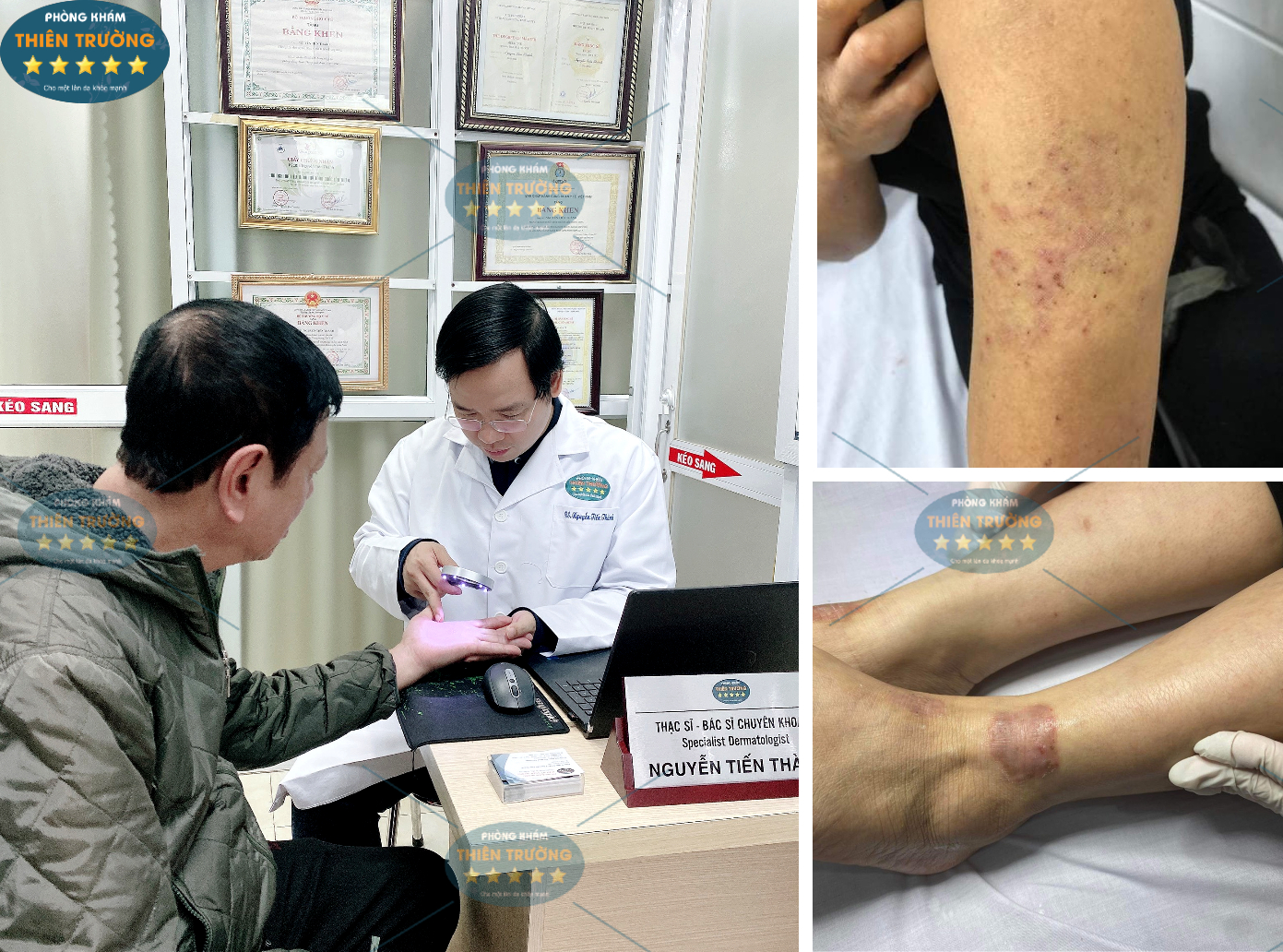 Hình ảnh: Thạc sĩ- Bác sĩ chuyên khoa II Nguyễn Tiến Thành đang khám da cho bệnh nhân.