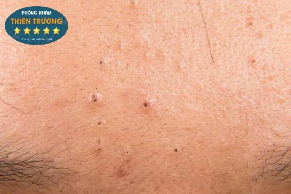 mun-dau-den-tren-tran