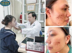 Hình ảnh: Mụn trứng cá.