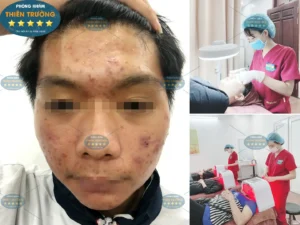 Hình ảnh: Khách hàng bị mụn trứng cá.