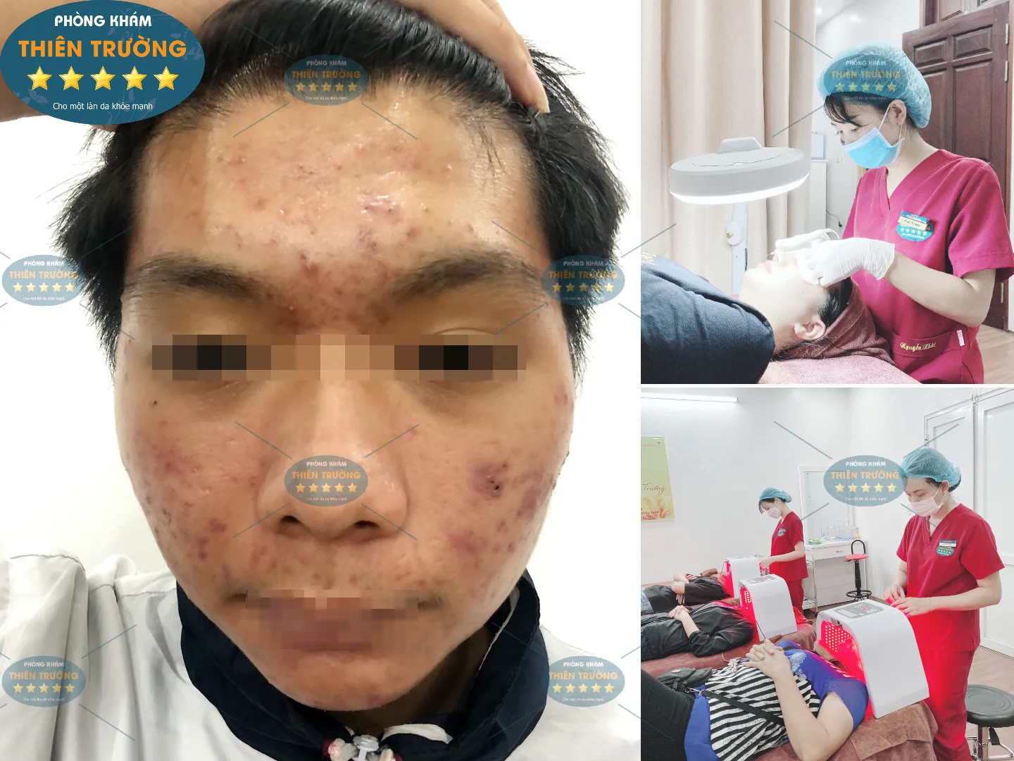 Hình ảnh: Khách hàng bị mụn trứng cá.