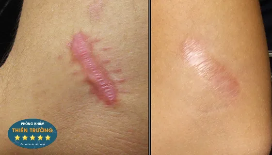 hinh-anh-seo-loi-truoc-va-sau-dieu-tri