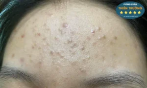 Hình ảnh: Mụn trứng cá.