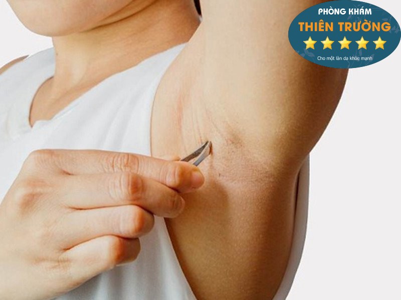 Hình ảnh : Nhổ lông