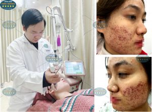 Hình ảnh: Khách hàng đang khám mụn tại phòng khám.