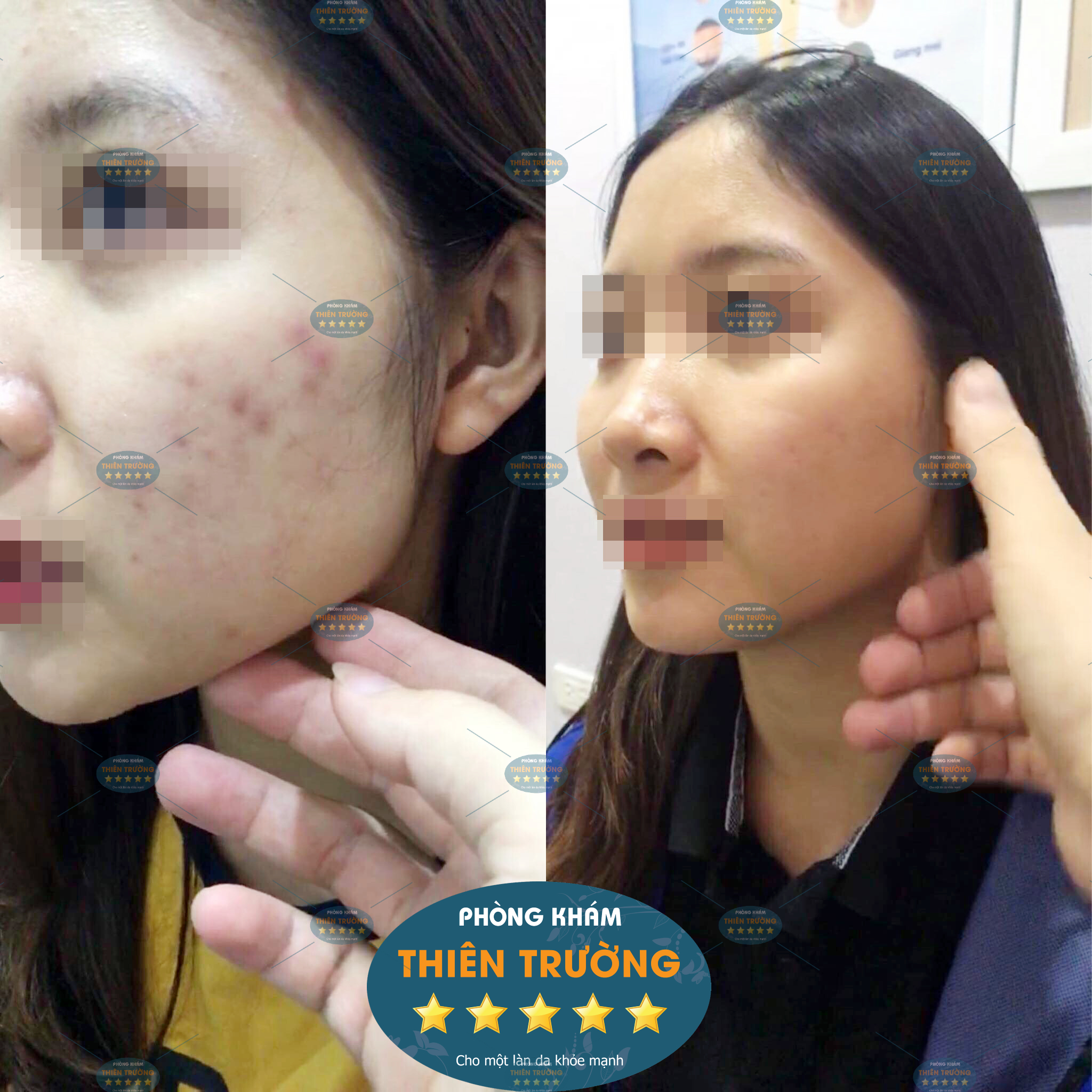 Hình ảnh: Trước và sau khi điều trị tại Phòng khám Da liễu thẩm mỹ Thiên Trường.