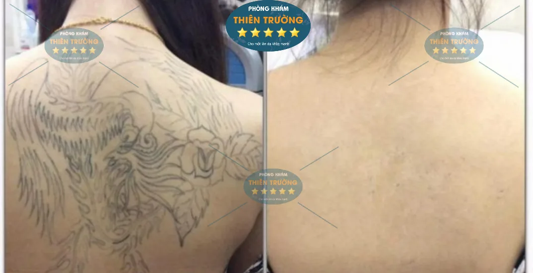 Hình ảnh: Hình xăm trước và sau khi xóa bằng công nghệ Laser