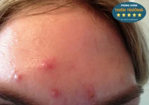 Hình ảnh: Mụn trứng cá.