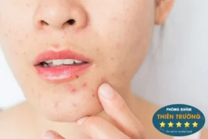 Hình ảnh: Mụn trứng cá.