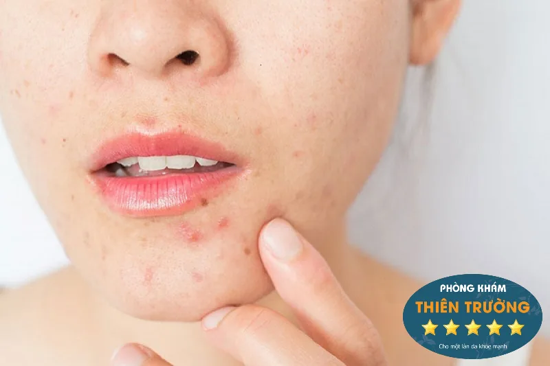 Hình ảnh: Mụn trứng cá.