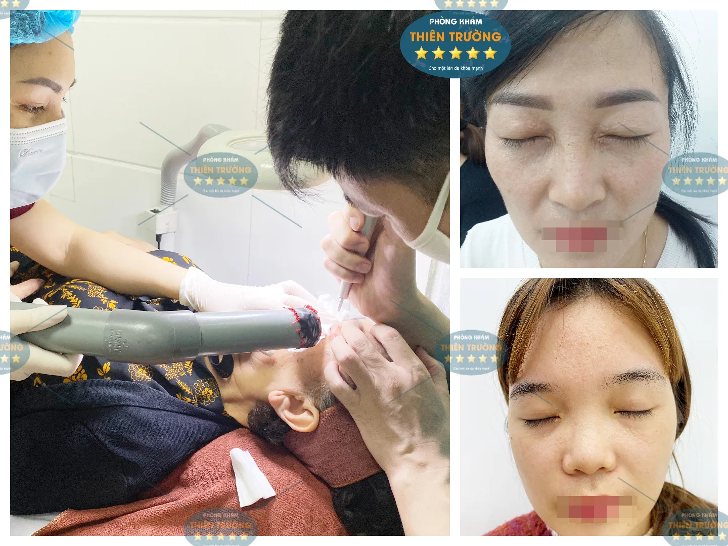 Hình ảnh: Bệnh nhân đang điều trị mụn thịt tại phòng khám Da liễu Thiên Trường