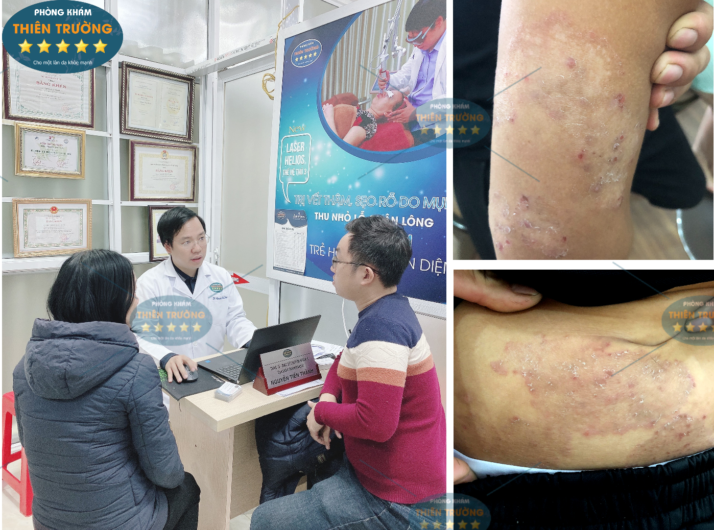 Hình ảnh: Thạc sĩ- Bác sĩ CK II Nguyễn Tiến Thành đang khám cho khách hàng tại Phòng khám Da liễu thẩm mỹ Thiên Trường.