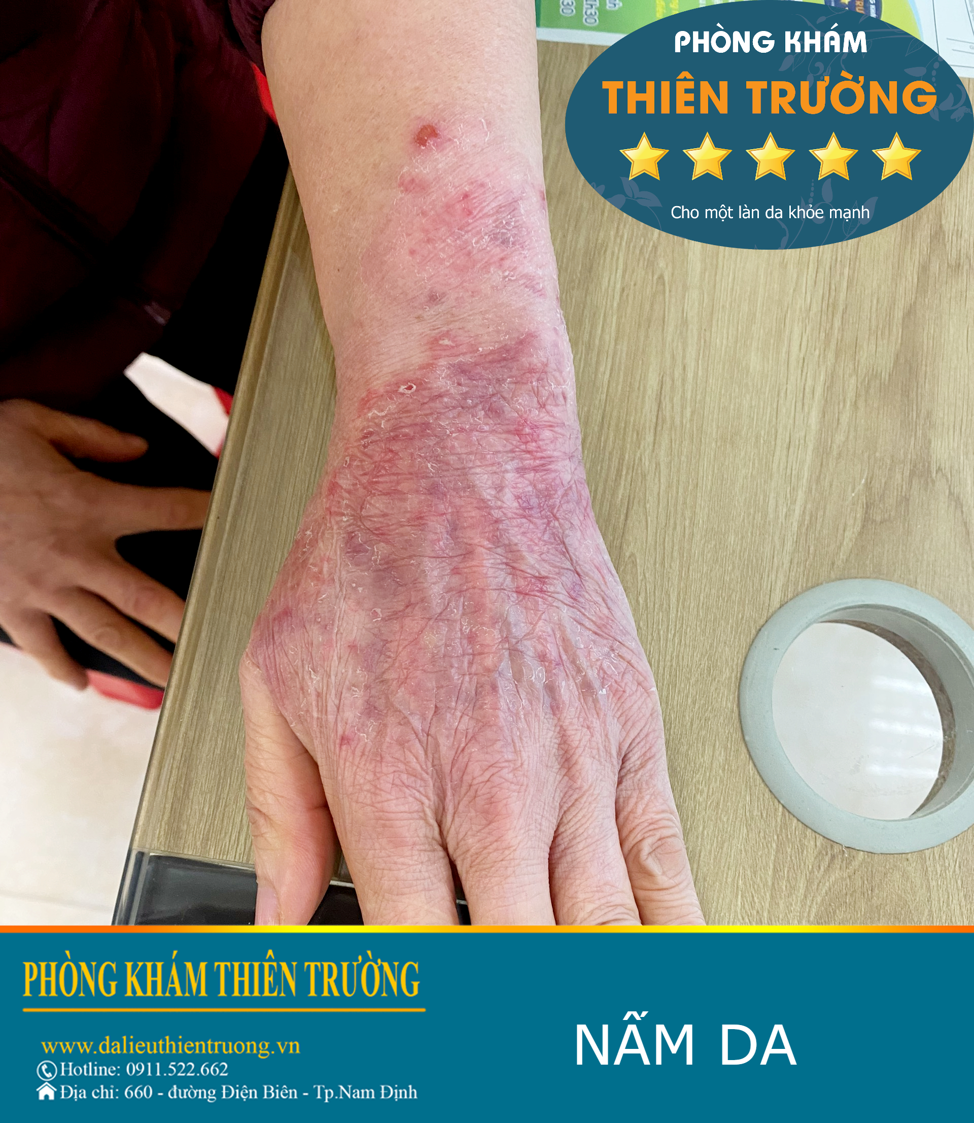 Hình ảnh: Nấm da