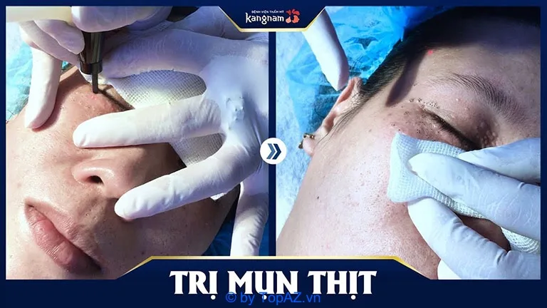 Hình ảnh: Bệnh viện thẩm mỹ Kangnam hỗ trợ điều trị mụn thịt cho khách hàng.