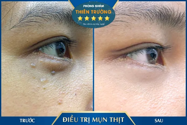 Hình ảnh: Mụn thịt.
