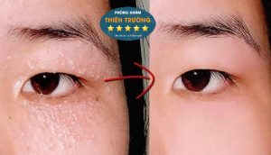 Hình ảnh: Trước và sau khi điều trị mụn thịt.