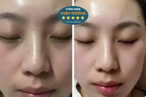 trước sau meso(1)
