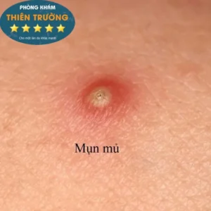 Hình ảnh: Mụn trứng cá.