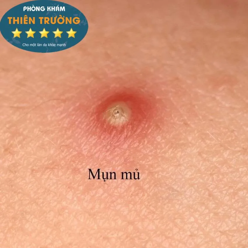 Hình ảnh: Mụn trứng cá.
