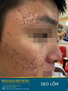 Hình ảnh: Sẹo lõm