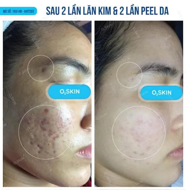 Hình ảnh: Phòng Khám Da Liễu O2 Skin.
