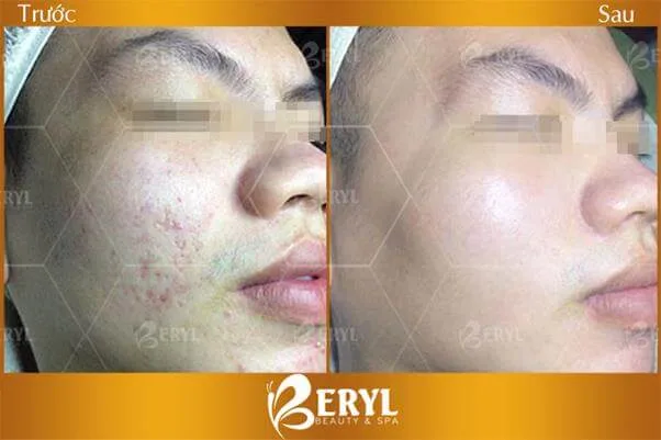 Hình ảnh: Beryl Beauty & Spa.