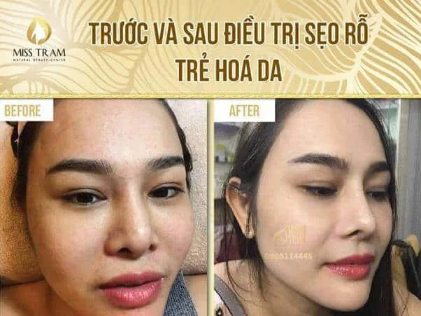 Hình ảnh: Miss Tram Natural Beauty Center – Thẩm Mỹ Viện.