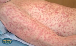 Hình ảnh: Bệnh giang mai – bệnh lây truyền qua đường tình dục